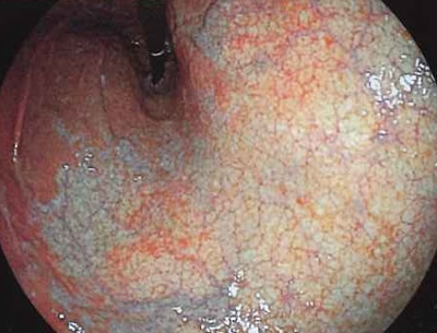 ピロリ菌の感染がさらに進行すると、粘膜が縮んで表面が左のような状態になります。
